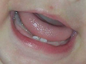 teeth-44